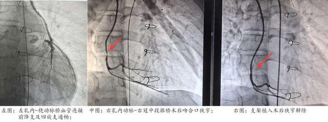 川崎病患儿冠脉搭桥术后血管再次狭窄，上海专家解难题